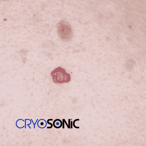Looking for pain free cherry angioma removal treatment Worcester? Call our team today! Worcester