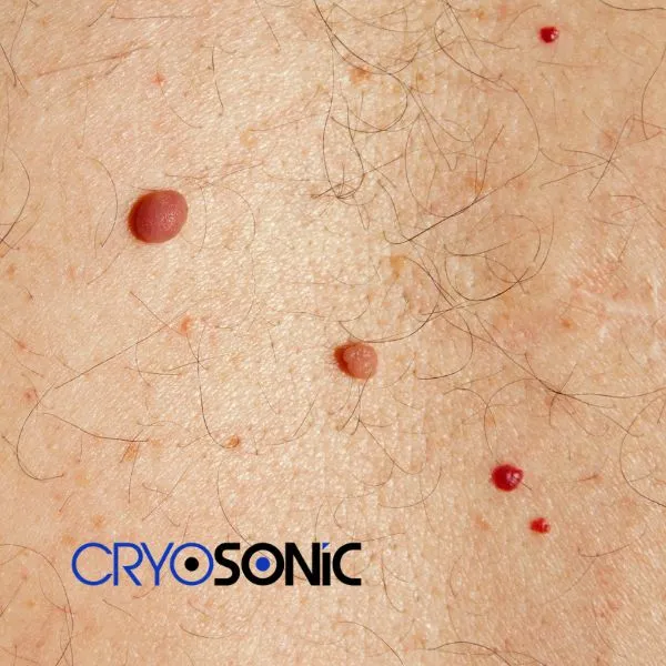 get cherry angioma removal treatment today! Worcester