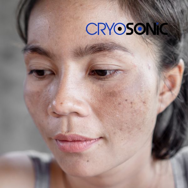 Ready to start age spots removal? Contact our team today in Worcester