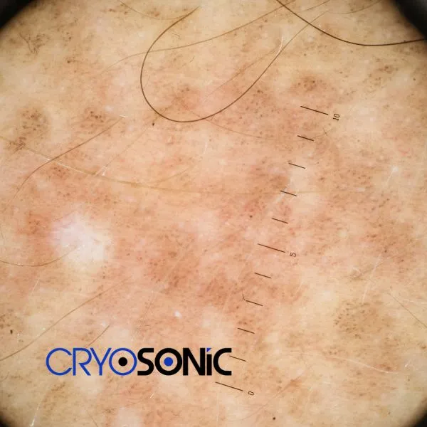 Speak to our team today about sun damaged skin treatment today in Worcester