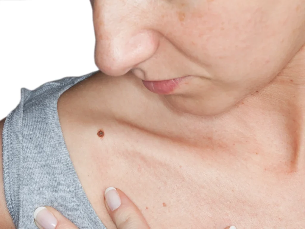 How Does CryoPen Sun Damage Treatment Worcester Work? Worcester