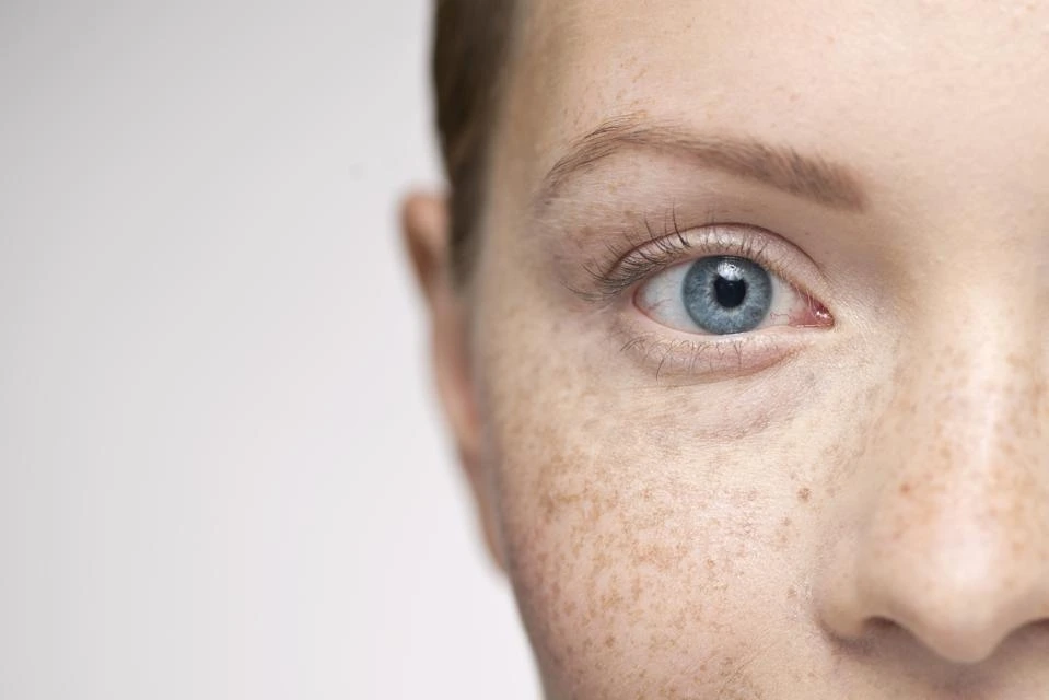 Understanding Sun Damage: How UV Rays Alter Skin and How CryoPen Can Reverse It Worcester