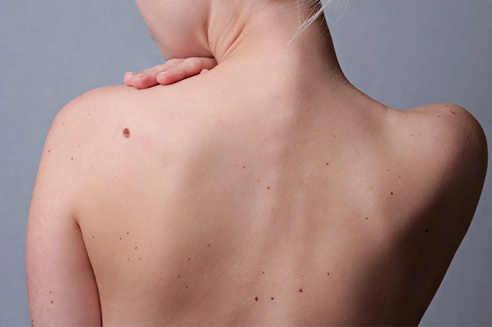 The Skin&rsquo;s Healing Journey After CryoPen Sun Damage Treatment Worcester