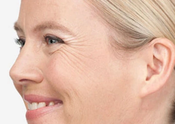 CryoPen Precision vs. Laser: Which Is Better for Sun-Damaged Skin? Worcester