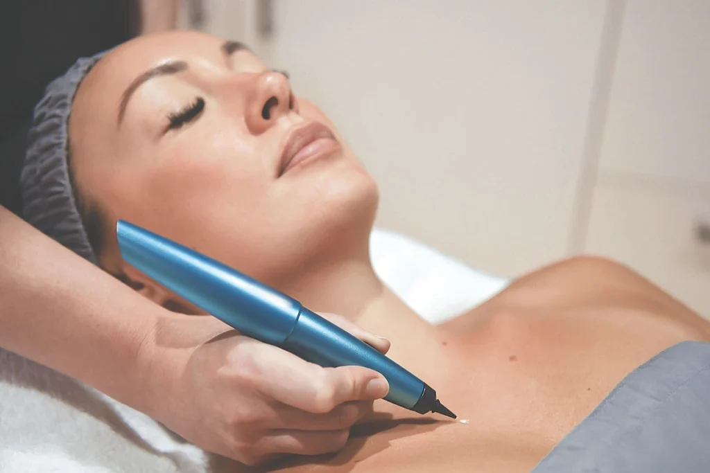 What is CryoPen Technology Worcester? Worcester