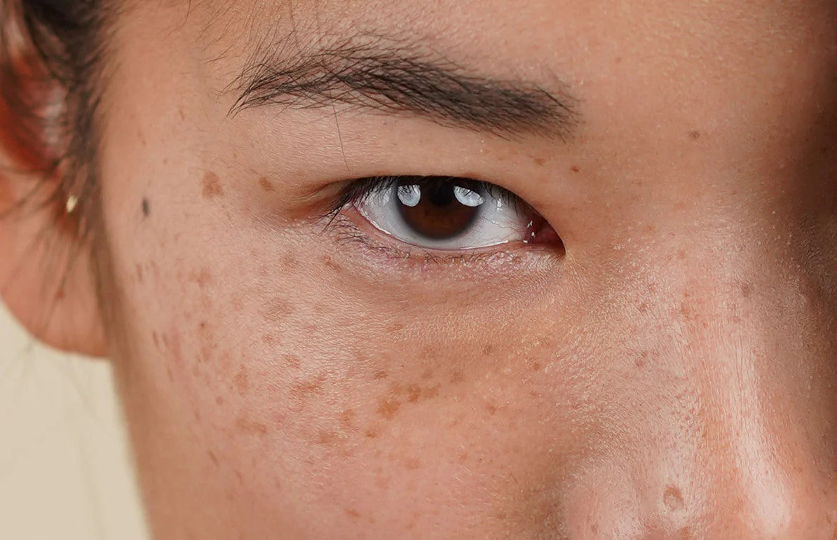Is There Any Risk of Scarring or Pigmentation Worcester? Worcester