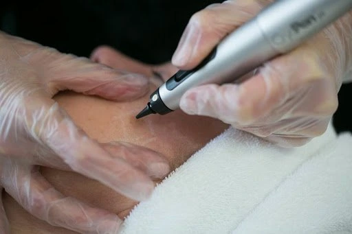 The CryoPen Technology Explained: How Extreme Cold Removes Sun-Damaged Skin Cells Worcester