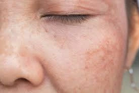 CryoPen Precision vs. Laser: Are Both Treatments Safe? Worcester
