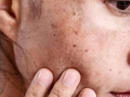 Why CryoPen Works Best for Isolated Sun Spots and Pigmentation Worcester