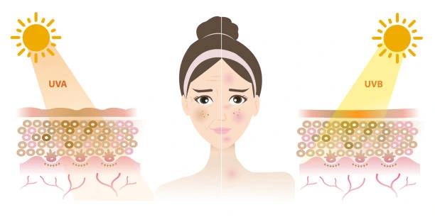 Understanding Sun Damage Worcester : How Do UV Rays Cause Changes in the Skin? Worcester