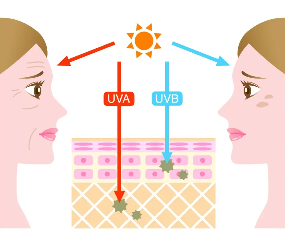 Understanding Sun Damage Worcester - Why Should Sun Damage Be Treated Early? Worcester